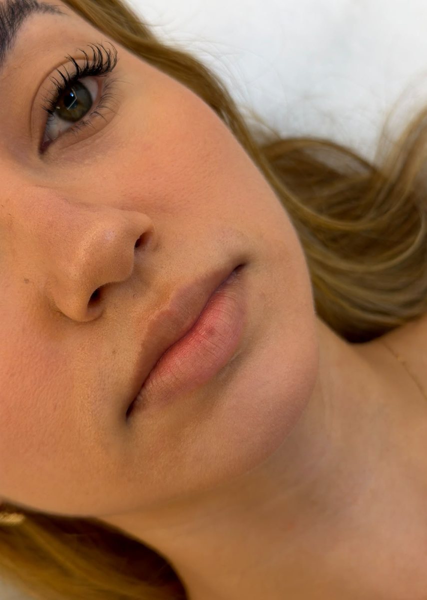 Antes — preenchimento labial