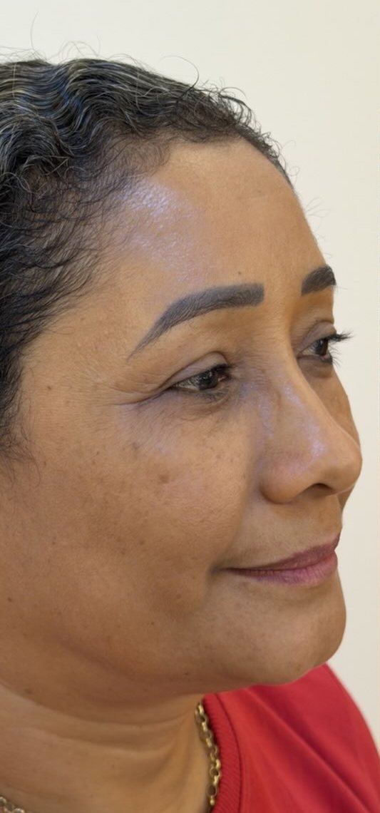 Antes — harmonização facial