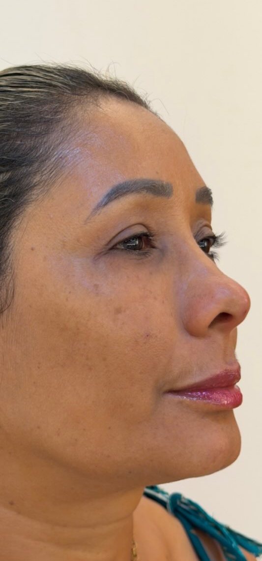 Depois — harmonização facial